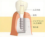 インプラント