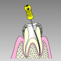 根管治療の内容