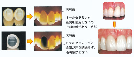 天然歯 オールセラミック金属を使用しないので透明感があり、自然