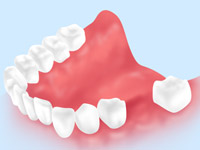インプラント・義歯
